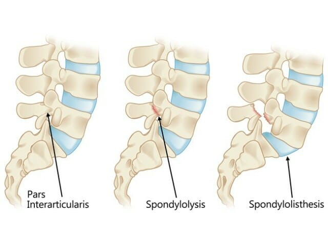 กระดูกสันหลังเคลื่อน spondylosis