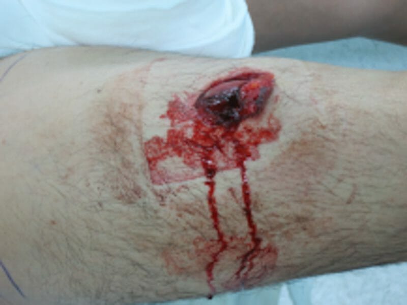 กระดูกหัก รักษาอย่างไร