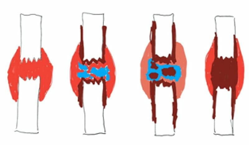 กระดูกหัก รักษาอย่างไร