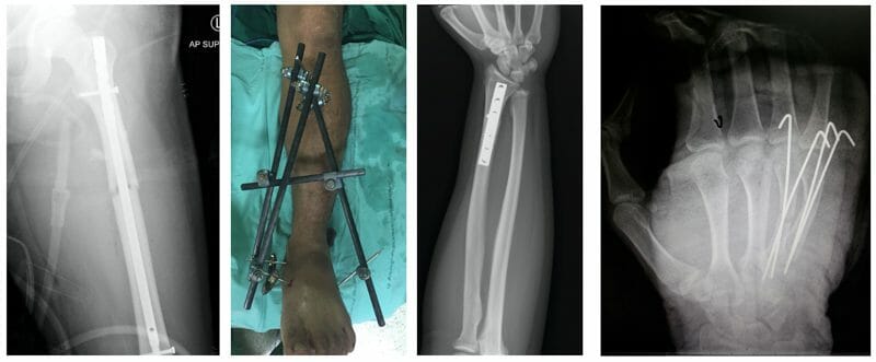 กระดูกหัก รักษาอย่างไร