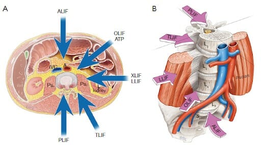 การผ่าตัดเชื่อมข้อกระดูกสันหลัง รักษากระดูกเคลื่อนทับเส้นประสาท lumbar interbody fusion