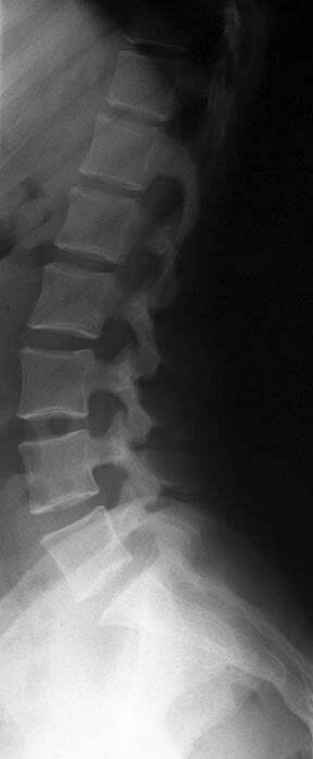 X-ray กระดูกสันหลัง X-ray กระดูกสันหลัง