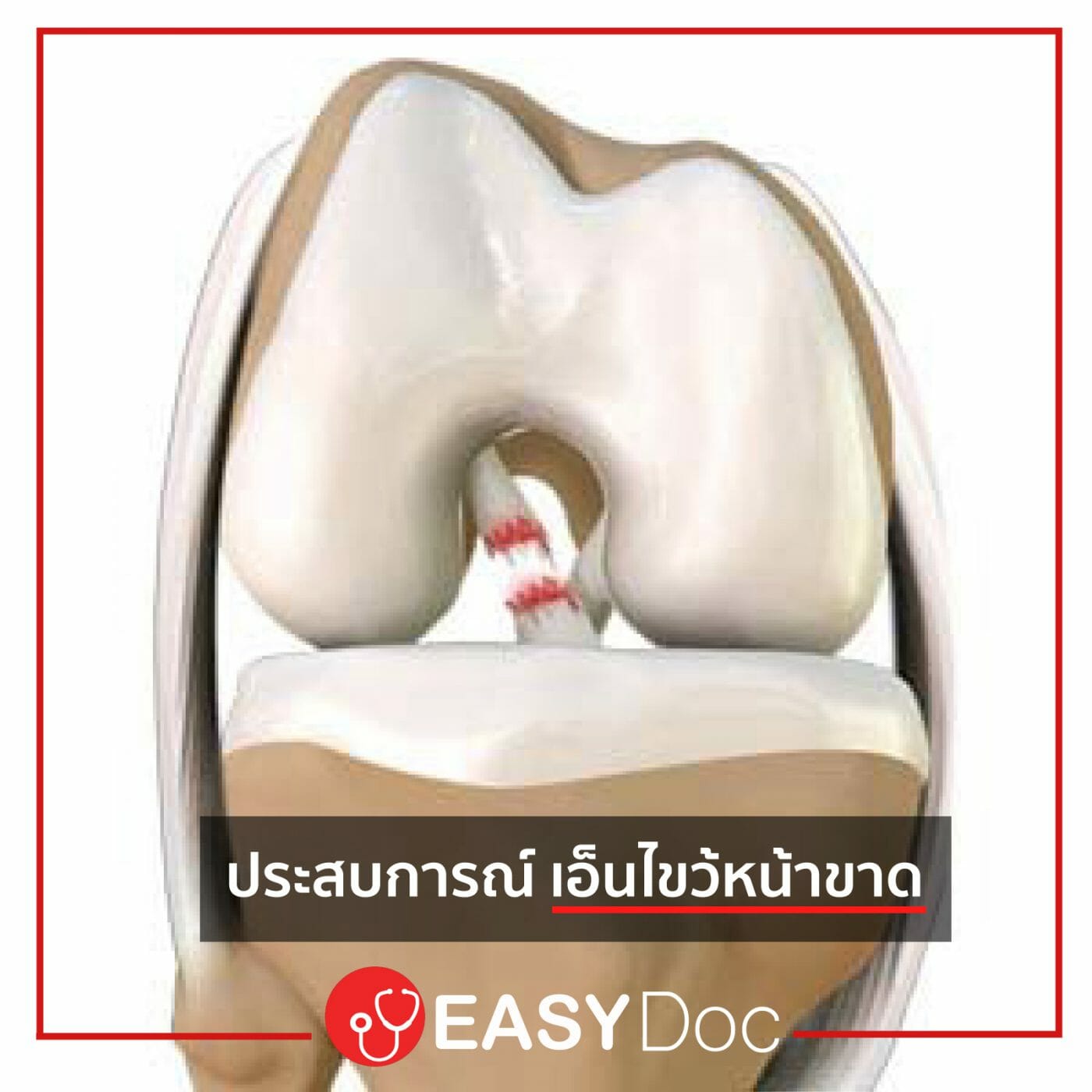 อาการ เอ็นไขว้หน้าขาด อาการ เอ็นไขว้หน้าขาด