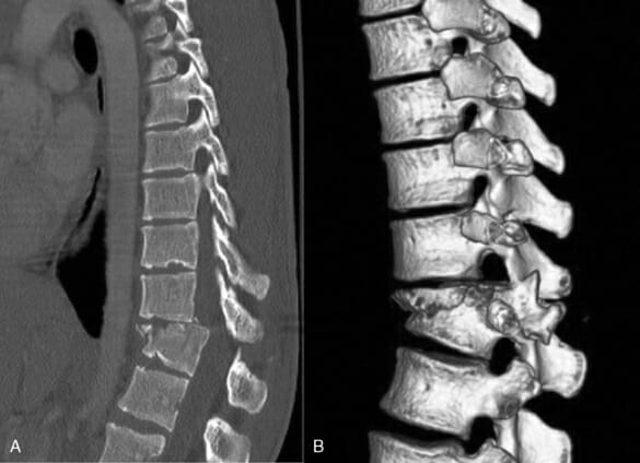 ภาพ ct scan กระดูกสันหลัง ภาพ ct scan กระดูกสันหลัง