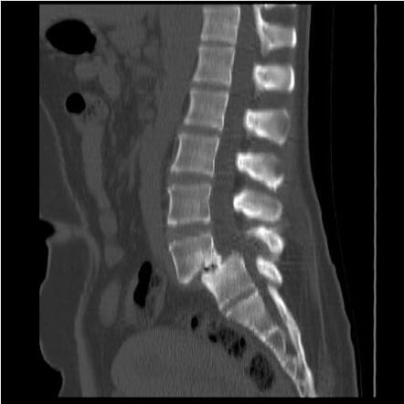 CT scan ในผู้ป่วยหมอนรองกระดูกสันหลังเคลื่อน