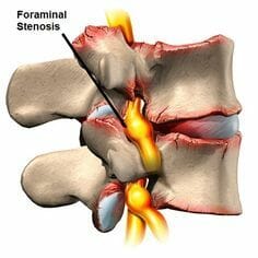 หมอนรองกระดูกทับเส้นประสาท หมอนรองกระดูกทับเส้นประสาท