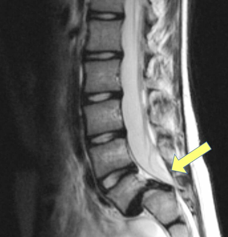 MRI ในผู้ป่วยหมอนรองกระดูกสันหลังเคลื่อน