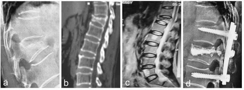 X-ray MRI กระดูกสันหลังยุบ X-ray MRI กระดูกสันหลังยุบ