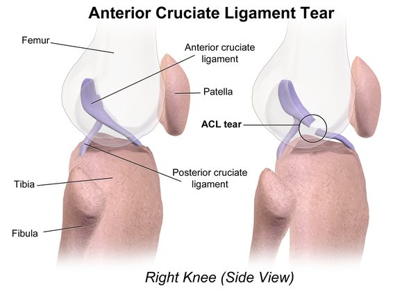 main qimg 58f15d89cf712828c6d113100220416b - Anterior cruciate ligament torn  (เส้นเอ็นไขว้หน้าฉีกขาด)