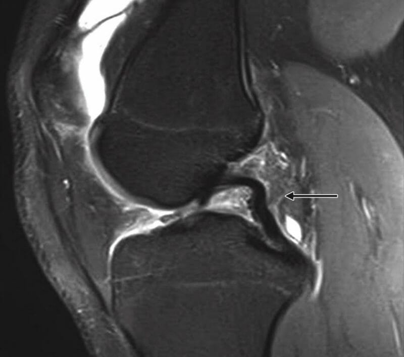 เส้นเอ็นไขว้หลังหย่อน (PCL buckling sign) mri เอ็นไขว้หน้าฉีกขาด