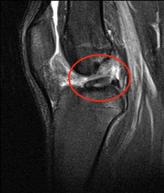 การฉีกขาดของเอ็นไขว้หน้าหรือ ACL การฉีกขาดของเอ็นไขว้หน้าหรือ ACL