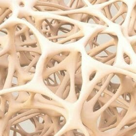 osteoporosis กระดูกพรุน osteoporosis กระดูกพรุน