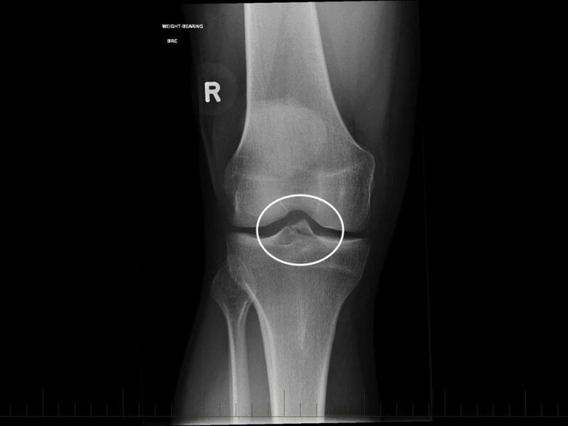 ACL Avulsion Fracture x-ray เอ็นไขว้หน้าฉีกขาด - 3