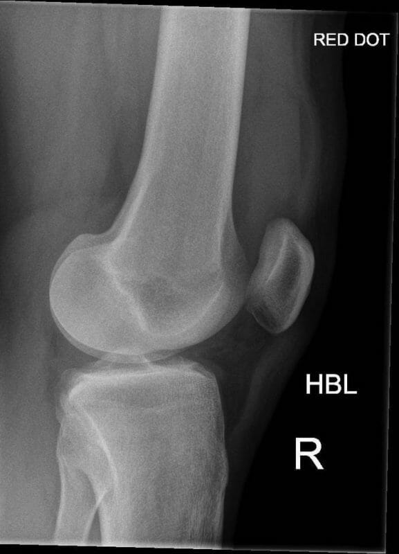 อาการบวมน้ำในเข่า (Effusion) จะเป็นลักษณะเงาดำที่บริเวณเข่า x-ray เอ็นไขว้หน้าฉีกขาด - 3