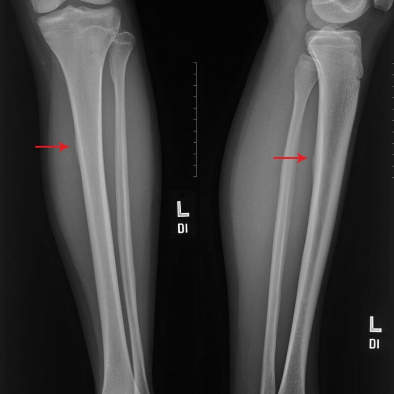 X-ray เห็นการหนาตัวของกระดูกหน้าแข้ง ในนักวิ่งที่มีอาการกระดูกหักล้า หรือ Stress Fracture กระดูกหน้าแข้งหัก นักวิ่งฝึกวิ่ง x-ray