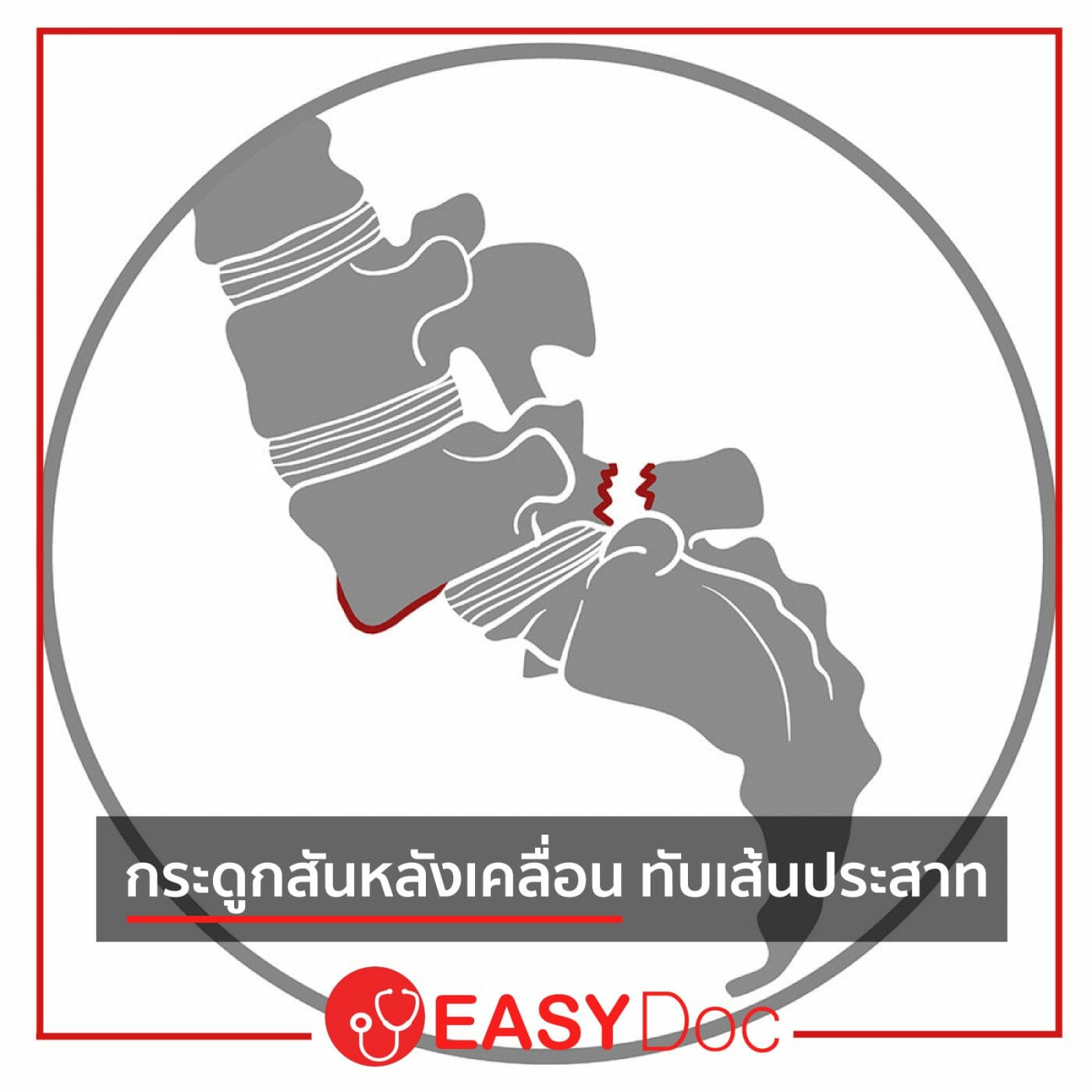 กระดูกสันหลังเคลื่อน-ทับเส้นประสาท