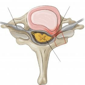 หมอนรองกระดูกคอทับเส้นประสาท-8