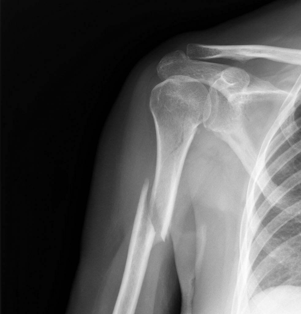 humerus fracture icd 10