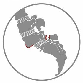 กระดูกสันหลังเคลื่อน ทับเส้นประสาท กระดูกสันหลังเคลื่อน ทับเส้นประสาท