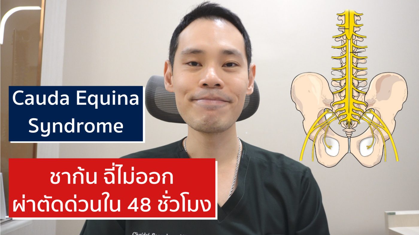 cauda equina syndrome